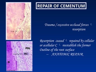 REPAIR OF CEMENTUM
Trauma / excessive occlusal forces 
resorption
Resorption ceased  repaired by cellular
or acellular C  reestablish the former
Outline of the root surface
-- ANATOMIC REPAIR
 