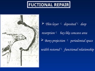 FUCTIONAL REPAIR
 Thin layer  deposited deep
resorption bay like concave area
 Bony projection  periodontal space
width restored functional relationship
 
