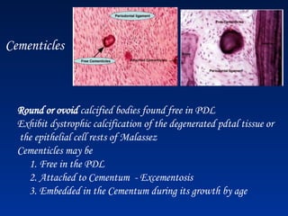 Cementicles
Round or ovoid calcified bodies found free in PDL
Exhibit dystrophic calcification of the degenerated pdtal tissue or
the epithelial cell rests of Malassez
Cementicles may be
1. Free in the PDL
2. Attached to Cementum - Excementosis
3. Embedded in the Cementum during its growth by age
 