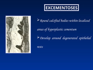 EXCEMENTOSES
Round calcified bodies within localized
areas of hyperplastic cementum
Develop around degenerated epithelial
rests
 