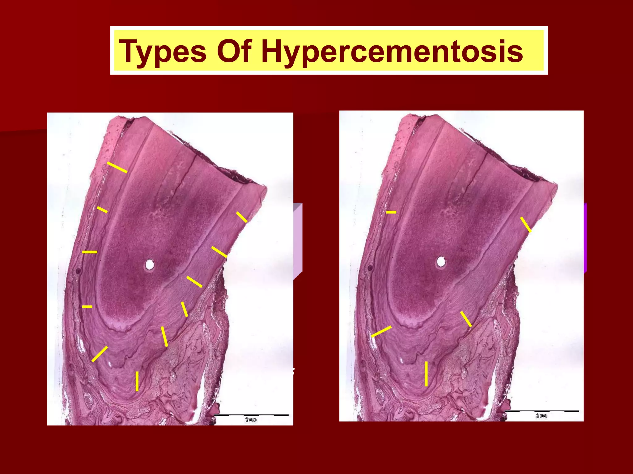 Hypercementosius Cementum 2014 | PPTX