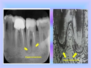 Hypercementosis
Hypercementosis
 