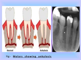 Fig:- Molars showing ankylosis
Normal Ankylosis
 