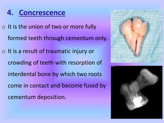 4. Concrescence
o It is the union of two or more fully
formed teeth through cementum only.
o It is a result of traumatic injury or
crowding of teeth with resorption of
interdental bone by which two roots
come in contact and become fused by
cementum deposition.
 