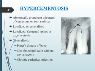Hypercementosis Radiographic Comprehensive Overview of Cementum: Structure, Types, and Clinical ...