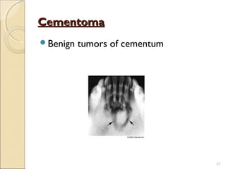 Cementum | PPT