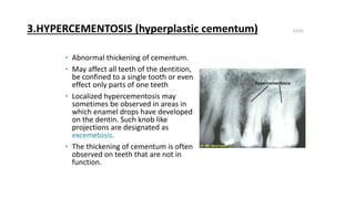 Hypercementation CEMENTUM IN HEALTH AND DISEASE.pptx