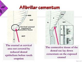 The enamel at cervical
area not covered by
reduced dental
epithelium before tooth
eruption
The connective tissue of the
dental sac lay down
cementum on the exposed
enamel
Afibrillar cementumAfibrillar cementum
 