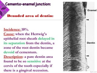  Denuded area of dentin:
Incidence: 10%.
Cause: when the Hertwig's
epithelial root sheath delayed in
its separation from the dentin, a
zone of the root dentin became
devoid of cementum.
Description: a pare dentin area
found to be so sensitive at the
cervix of the tooth especially if
there is a gingival recession.
Cemento-enamel junction:Cemento-enamel junction:
 