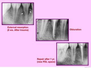 External resorption
(8 ws. After trauma) Obturation
Repair after 1 yr.
(new PDL space)
 