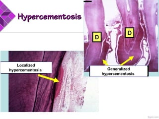 Localized
hypercementosis Generalized
hypercementosis
HypercementosisHypercementosis
 
