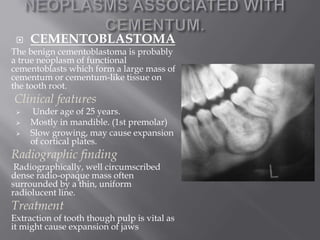 Cementum ppt | PPTX