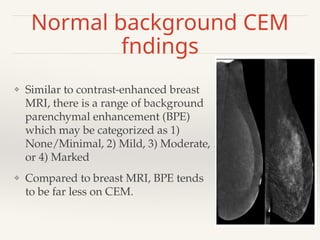 Contrast enhanced mammography: Diagnostic.pptx