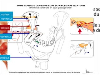 1.contrac
2.contrac
2.ontrac
2.contrac
3.+contrac
 