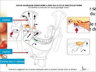 contrac
contrac
Contrac des m abaisse
 