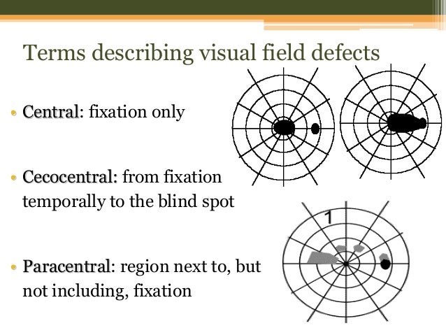 Visual Field Defects Chart