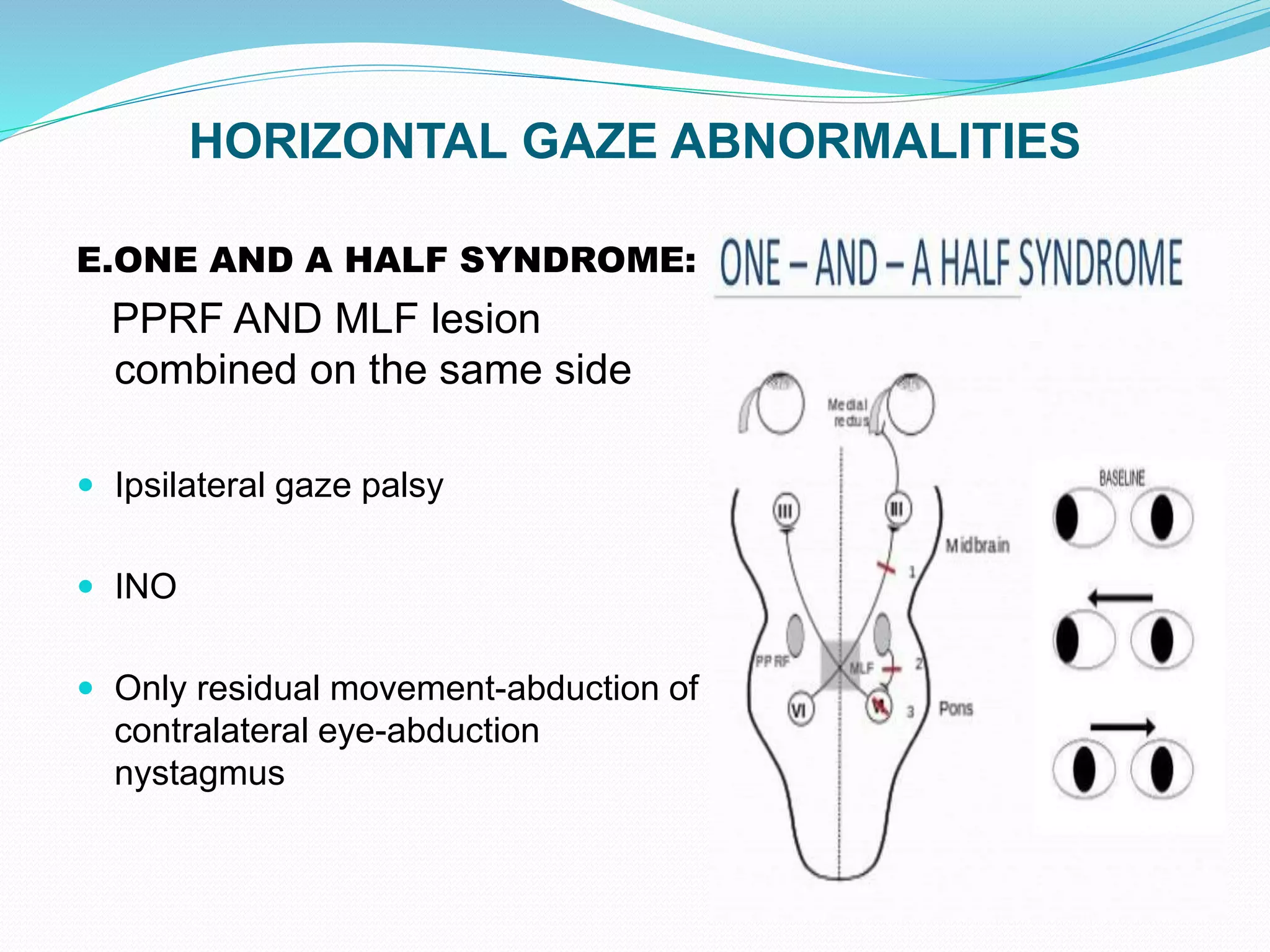 HORIZONTAL GAZE ABNORMALITIES
E.ONE AND A HALF SYNDROME:
PPRF AND MLF lesion
combined on the same side
 Ipsilateral gaze palsy
 INO
 Only residual movement-abduction of
contralateral eye-abduction
nystagmus
 