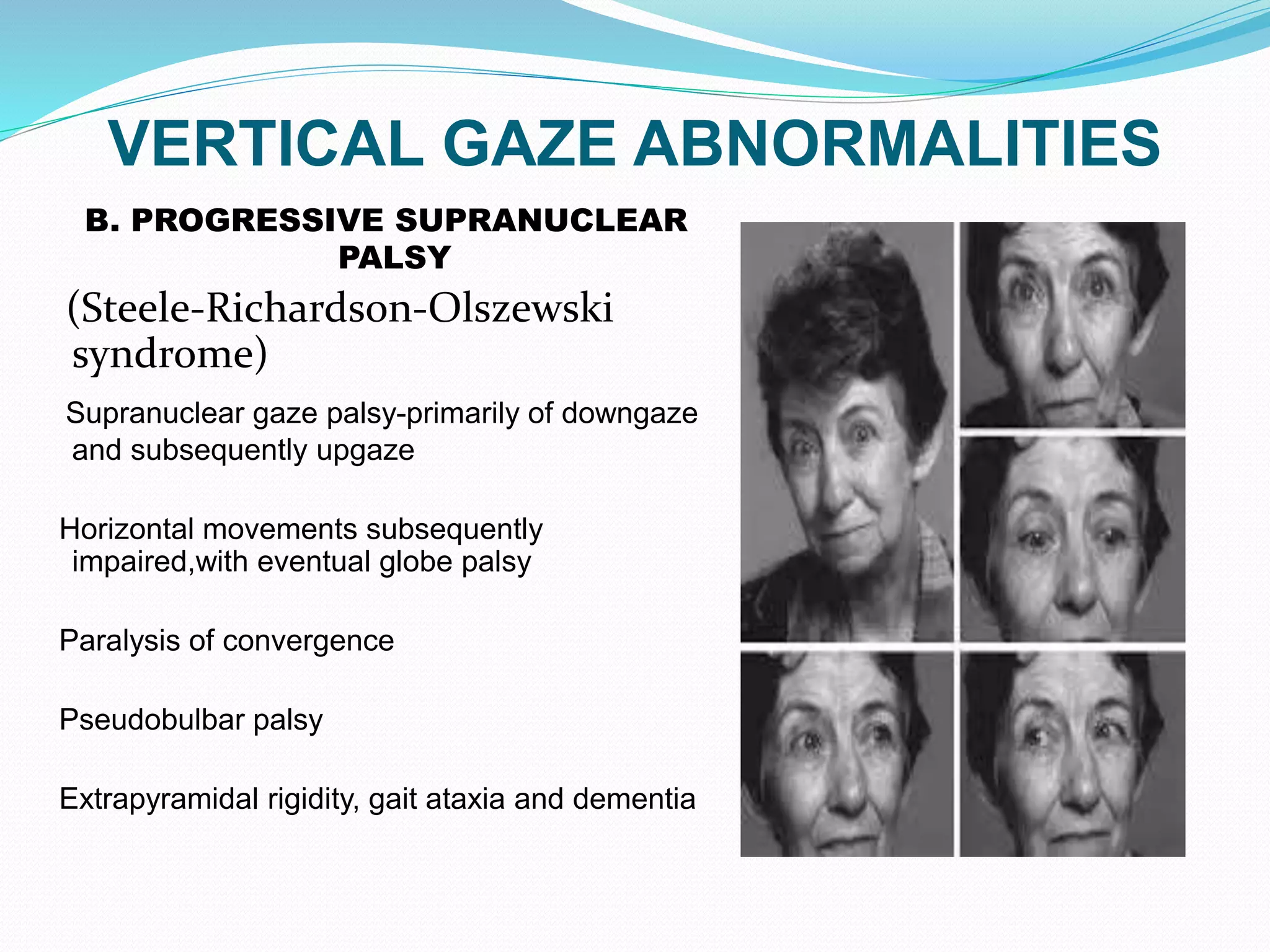 VERTICAL GAZE ABNORMALITIES
B. PROGRESSIVE SUPRANUCLEAR
PALSY
(Steele-Richardson-Olszewski
syndrome)
Supranuclear gaze palsy-primarily of downgaze
and subsequently upgaze
Horizontal movements subsequently
impaired,with eventual globe palsy
Paralysis of convergence
Pseudobulbar palsy
Extrapyramidal rigidity, gait ataxia and dementia
 