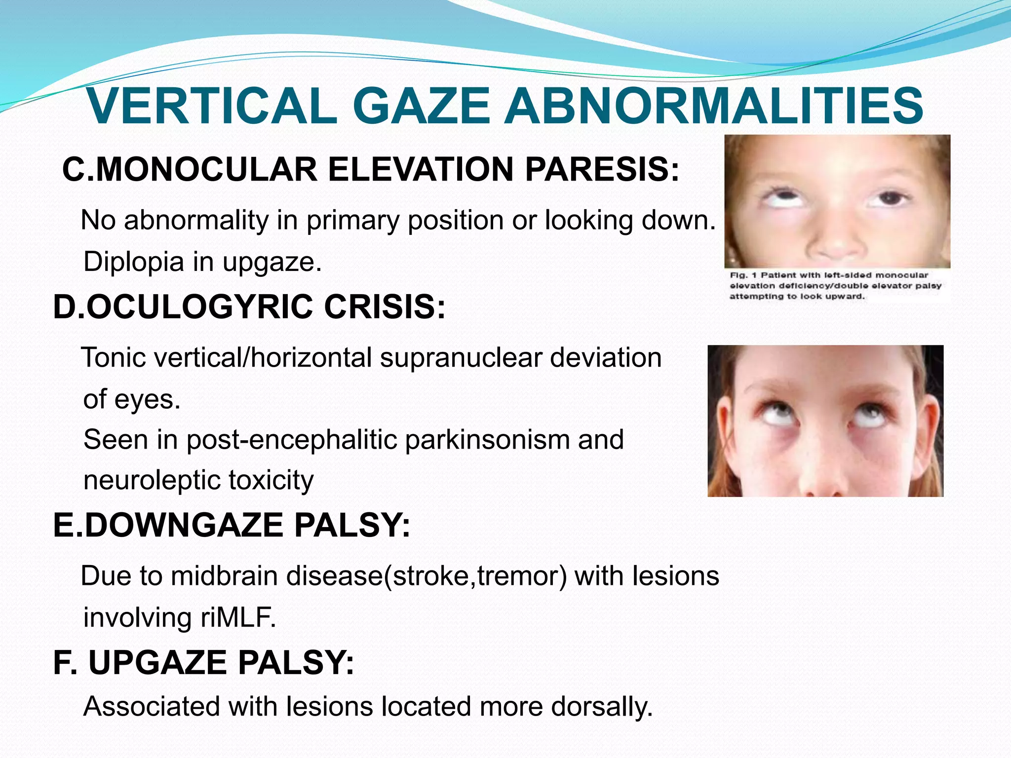 VERTICAL GAZE ABNORMALITIES
C.MONOCULAR ELEVATION PARESIS:
No abnormality in primary position or looking down.
Diplopia in upgaze.
D.OCULOGYRIC CRISIS:
Tonic vertical/horizontal supranuclear deviation
of eyes.
Seen in post-encephalitic parkinsonism and
neuroleptic toxicity
E.DOWNGAZE PALSY:
Due to midbrain disease(stroke,tremor) with lesions
involving riMLF.
F. UPGAZE PALSY:
Associated with lesions located more dorsally.
 
