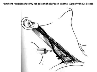 Pertinent regional anatomy for posterior approach internal jugular venous access
 