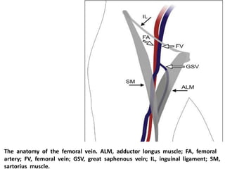 The anatomy of the femoral vein. ALM, adductor longus muscle; FA, femoral
artery; FV, femoral vein; GSV, great saphenous vein; IL, inguinal ligament; SM,
sartorius muscle.
 