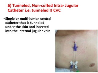 6) Tunneled, Non-cuffed Intra- Jugular
Catheter i.e. tunneled IJ CVC
•Single or multi-lumen central
catheter that is tunneled
under the skin and inserted
into the internal jugular vein
 
