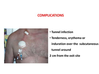 • Tunnel infection
• Tenderness, erythema or
induration over the subcutaneous
tunnel around
2 cm from the exit site
COMPLICATIONS
 
