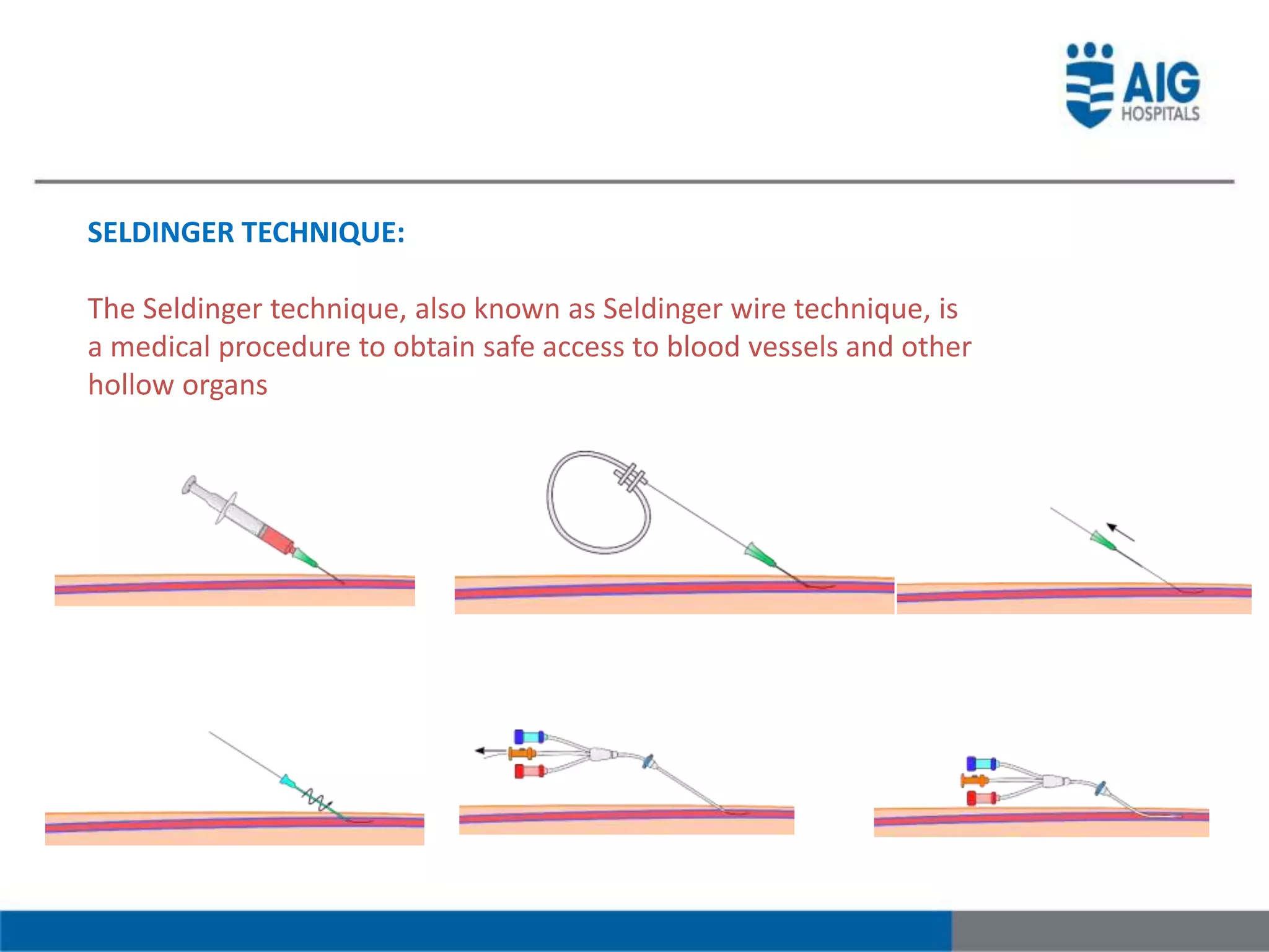 SELDINGER TECHNIQUE:
The Seldinger technique, also known as Seldinger wire technique, is
a medical procedure to obtain safe access to blood vessels and other
hollow organs
 