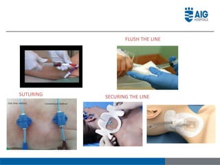 FLUSH THE LINE
SUTURING SECURING THE LINE
 