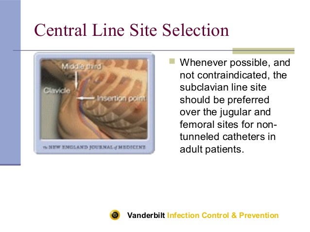 catheter associated bloodstream infection essay catheter associated bloodstream infection essay