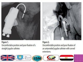 Central line insertion | PDF