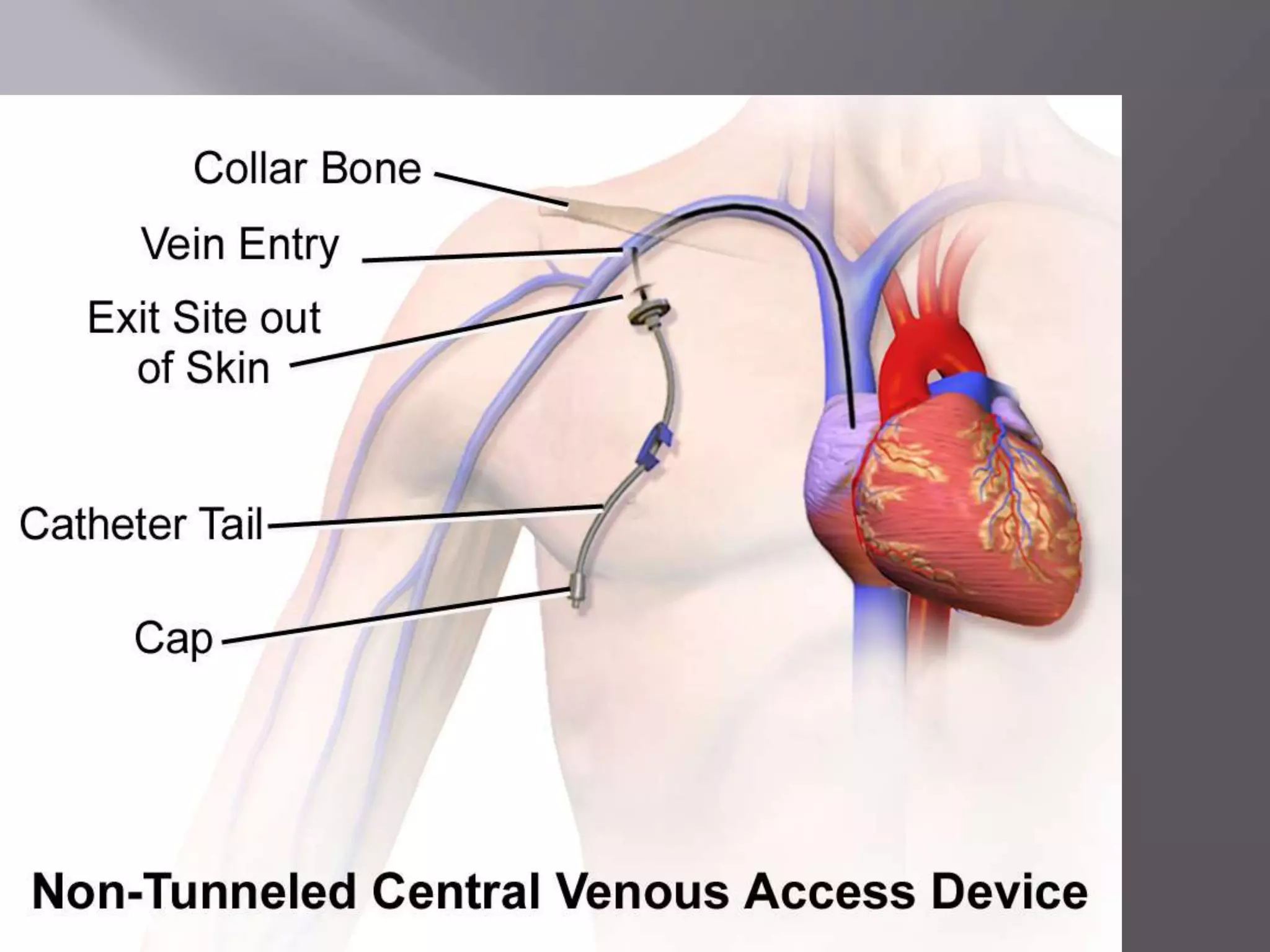 CENTRAL LINE INSERTION AND CARE.pptx