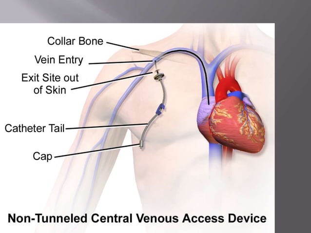 CENTRAL LINE INSERTION AND CARE.pptx | Heart and Cardiovascular ...