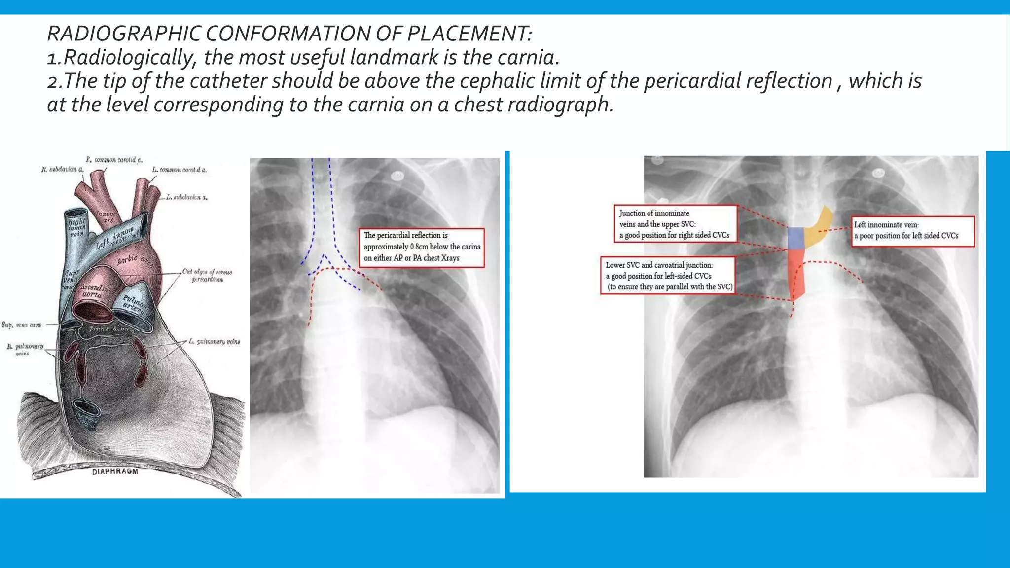 RADIOGRAPHIC CONFORMATION OF PLACEMENT:
1.Radiologically, the most useful landmark is the carnia.
2.The tip of the catheter should be above the cephalic limit of the pericardial reflection , which is
at the level corresponding to the carnia on a chest radiograph.
 