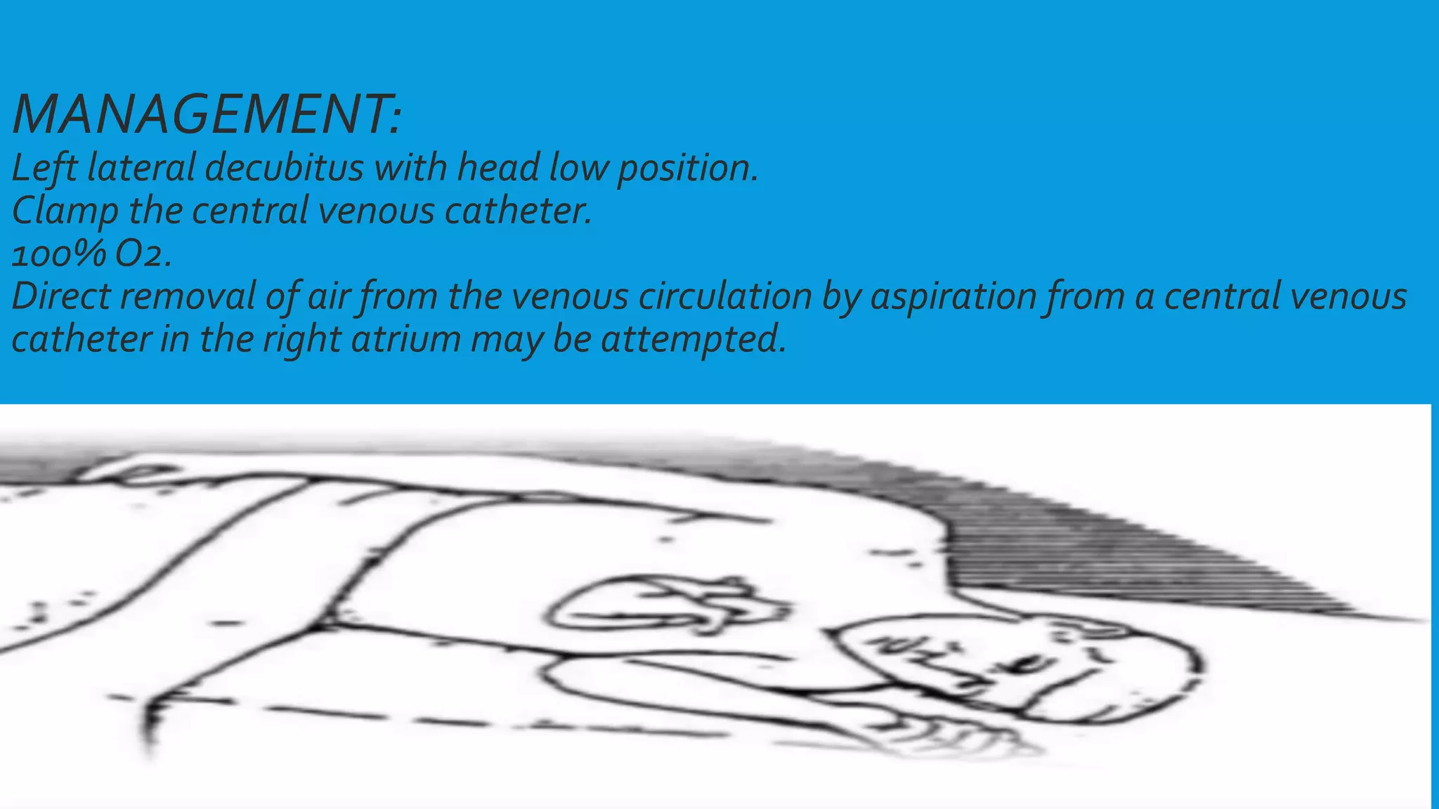 MANAGEMENT:
Left lateral decubitus with head low position.
Clamp the central venous catheter.
100% O2.
Direct removal of air from the venous circulation by aspiration from a central venous
catheter in the right atrium may be attempted.
 