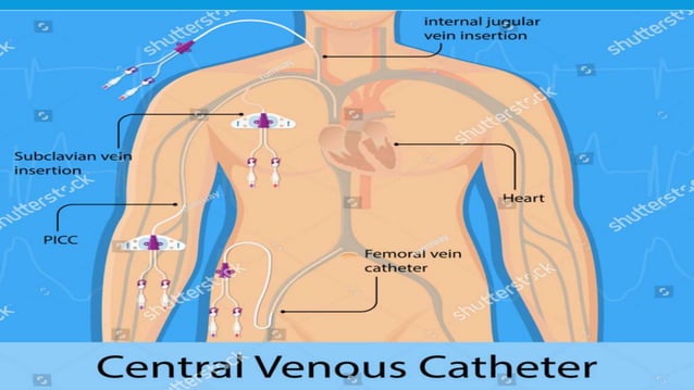 Center Line Insertion Central line placement | PPTX | First Aid | Injuries