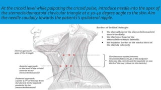 At the cricoid level while palpating the cricoid pulse, introduce needle into the apex of
the sternocleidomastoid-clavicular triangle at a 30-40 degree angle to the skin.Aim
the needle caudally towards the patients’s ipsilateral nipple.
 