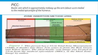 PICC:
Basilic vein which is approximately midway up the arm (about 12cm medial
to the medial epicondyle of the humerus.
 