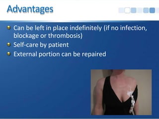 Advantages
Can be left in place indefinitely (if no infection,
blockage or thrombosis)
Self-care by patient
External portion can be repaired
 