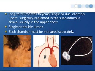 long-term (months to years) single or dual chamber
“port” surgically implanted in the subcutaneous
tissue, usually in the upper chest
Single or double lumen.
Each chamber must be managed separately.
 