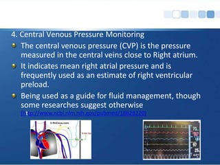 4. Central Venous Pressure Monitoring
The central venous pressure (CVP) is the pressure
measured in the central veins close to Right atrium.
It indicates mean right atrial pressure and is
frequently used as an estimate of right ventricular
preload.
Being used as a guide for fluid management, though
some researches suggest otherwise
(http://www.ncbi.nlm.nih.gov/pubmed/18628220)
 