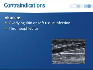 Contraindications
Absolute
Overlying skin or soft tissue infection
Thrombophlebitis
 