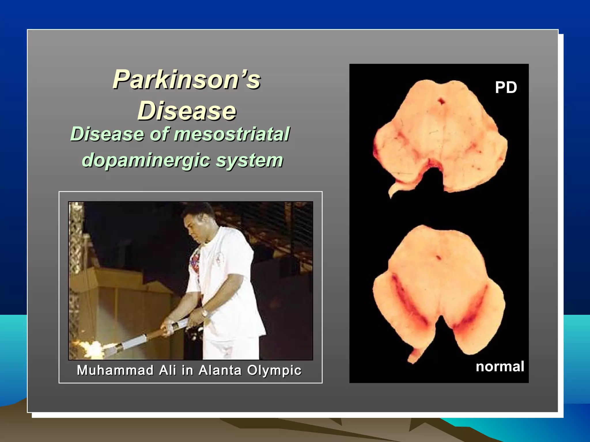 Parkinson’s                    PD
     Disease
Disease of mesostriatal
 dopaminergic system




Muhammad Ali in Alanta Olympic   normal
 