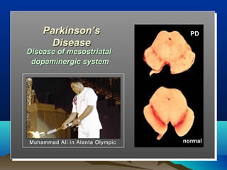 Parkinson’s                    PD
     Disease
Disease of mesostriatal
 dopaminergic system




Muhammad Ali in Alanta Olympic   normal
 