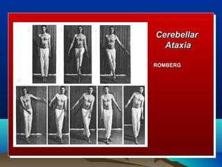 a   b   c
                Cerebellar
                  Ataxia

                ROMBERG

d
 