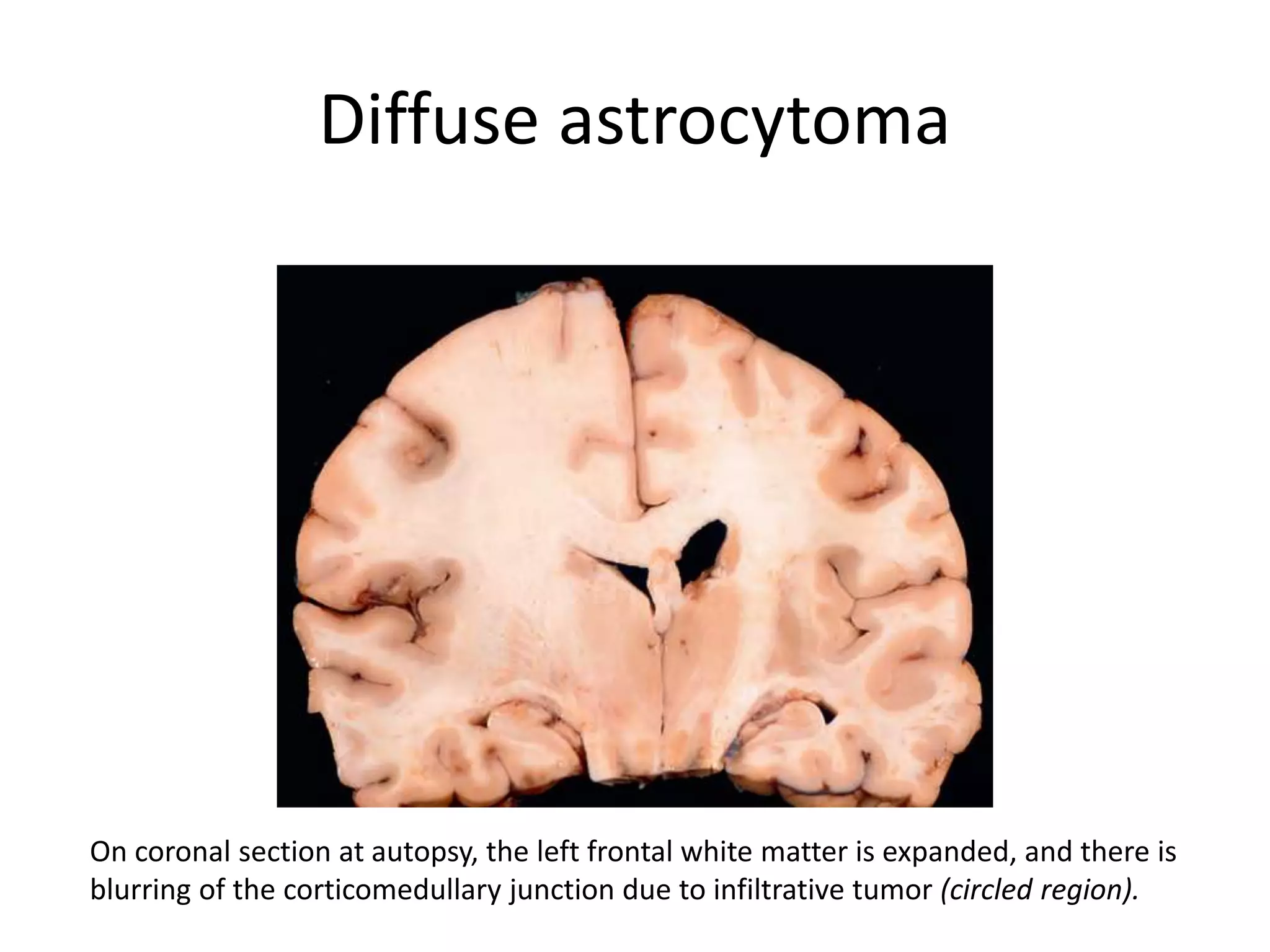 Diffuse astrocytoma
On coronal section at autopsy, the left frontal white matter is expanded, and there is
blurring of the corticomedullary junction due to infiltrative tumor (circled region).
 