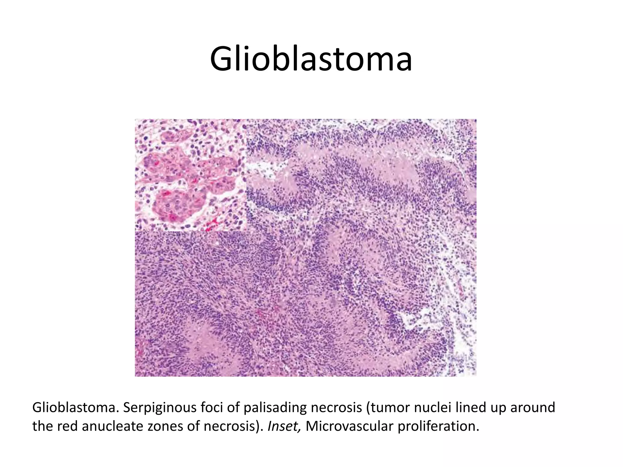Glioblastoma
Glioblastoma. Serpiginous foci of palisading necrosis (tumor nuclei lined up around
the red anucleate zones of necrosis). Inset, Microvascular proliferation.
 