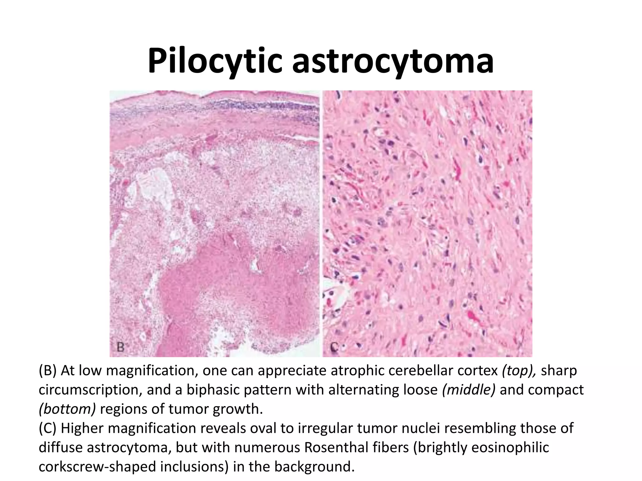 Pilocytic astrocytoma
(B) At low magnification, one can appreciate atrophic cerebellar cortex (top), sharp
circumscription, and a biphasic pattern with alternating loose (middle) and compact
(bottom) regions of tumor growth.
(C) Higher magnification reveals oval to irregular tumor nuclei resembling those of
diffuse astrocytoma, but with numerous Rosenthal fibers (brightly eosinophilic
corkscrew-shaped inclusions) in the background.
 