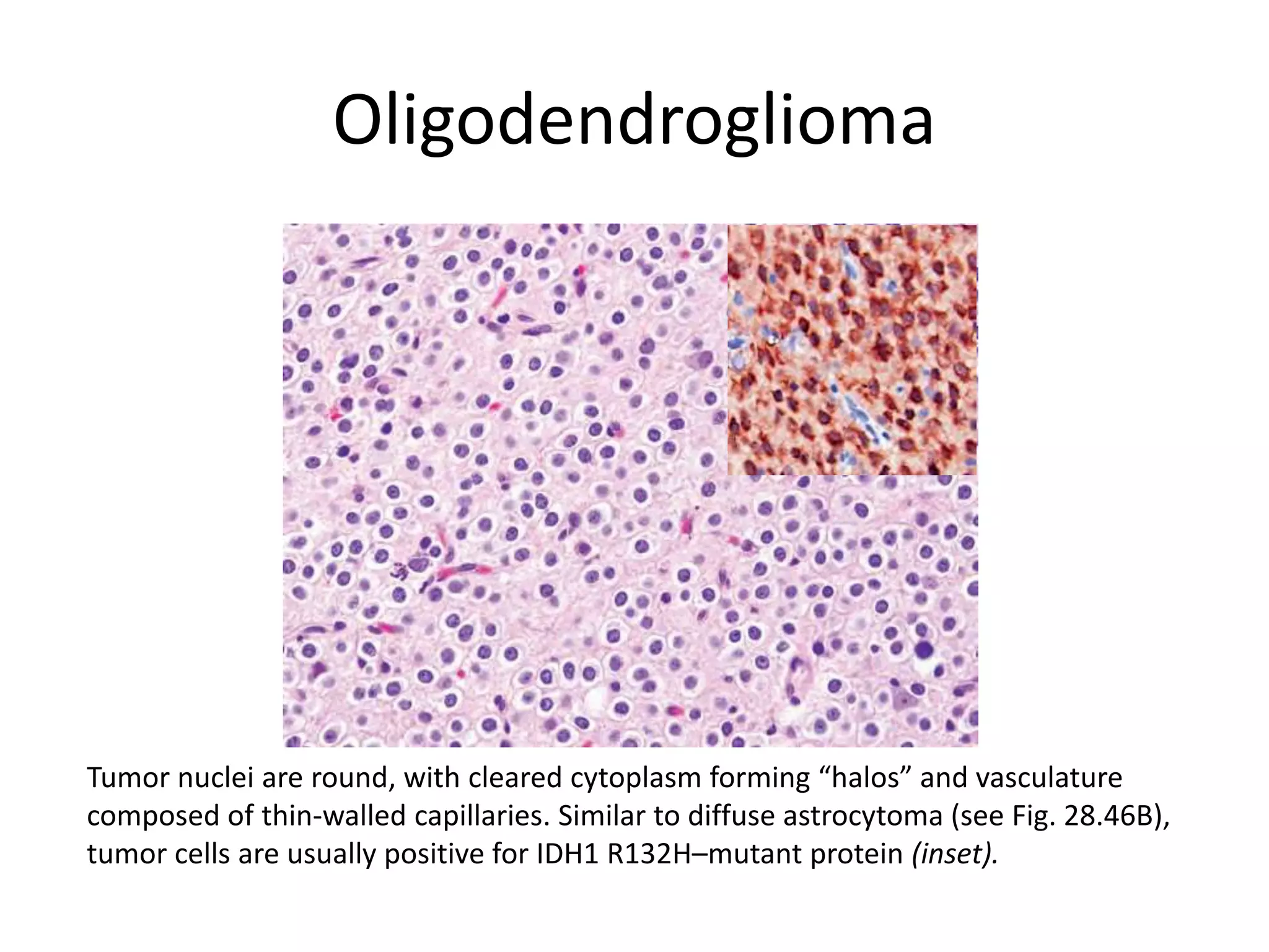 Oligodendroglioma
Tumor nuclei are round, with cleared cytoplasm forming “halos” and vasculature
composed of thin-walled capillaries. Similar to diffuse astrocytoma (see Fig. 28.46B),
tumor cells are usually positive for IDH1 R132H–mutant protein (inset).
 