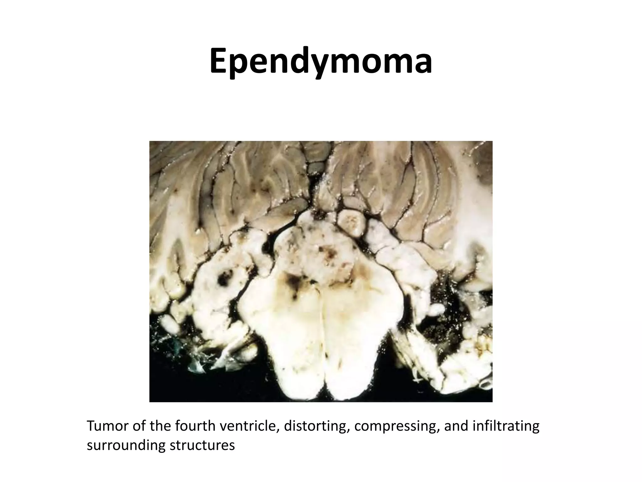 Ependymoma
Tumor of the fourth ventricle, distorting, compressing, and infiltrating
surrounding structures
 